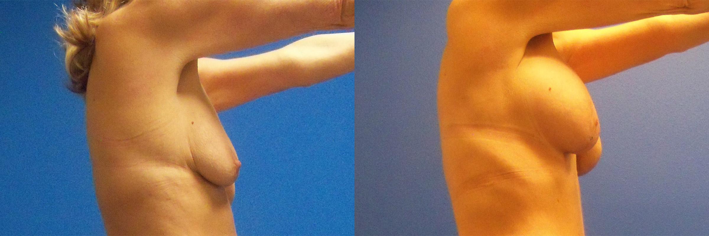 Hidden Breast Aug and Lift Before & After Gallery - Patient 382566 - Image 2