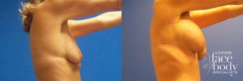 Hidden Breast Aug and Lift Before & After Gallery - Patient 382566 - Image 2