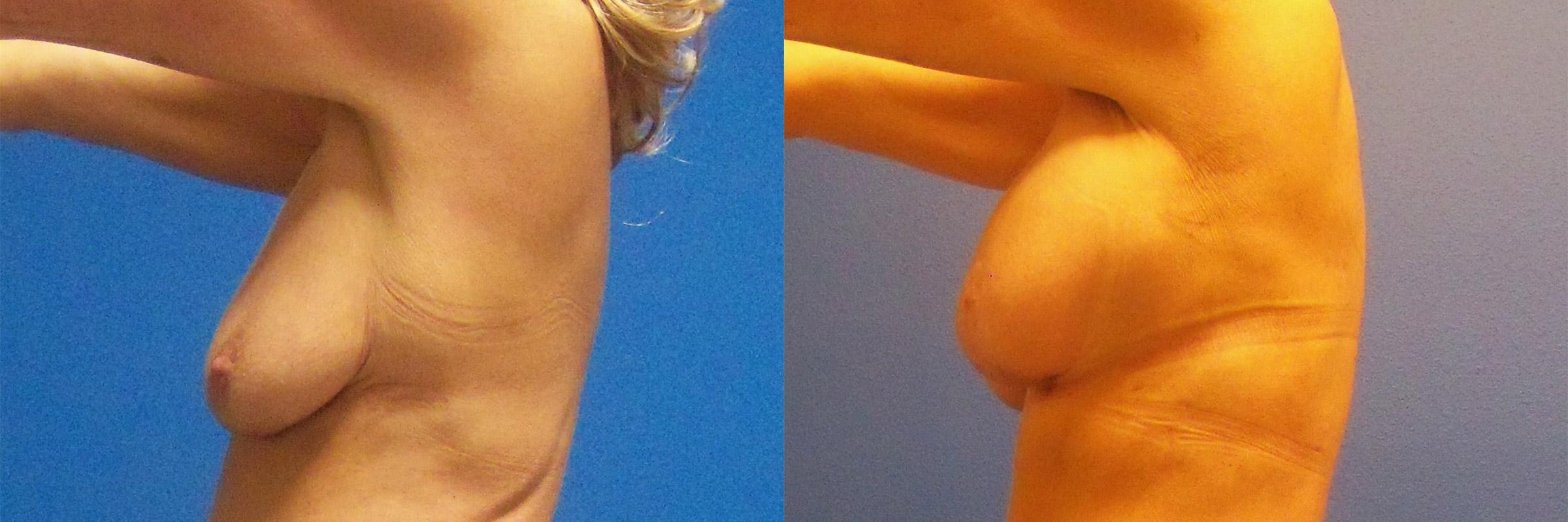 Hidden Breast Aug and Lift Before & After Gallery - Patient 382566 - Image 3