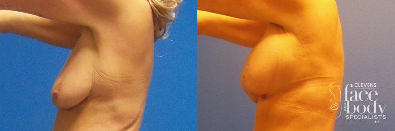 Hidden Breast Aug and Lift Before & After Gallery - Patient 382566 - Image 3