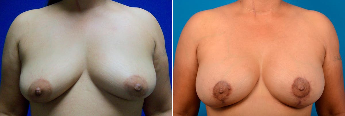 Breast Augmentation and Lift Before & After Gallery - Patient 109858 - Image 1