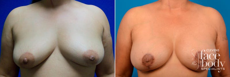 Hidden Breast Aug and Lift Before & After Gallery - Patient 267986 - Image 1
