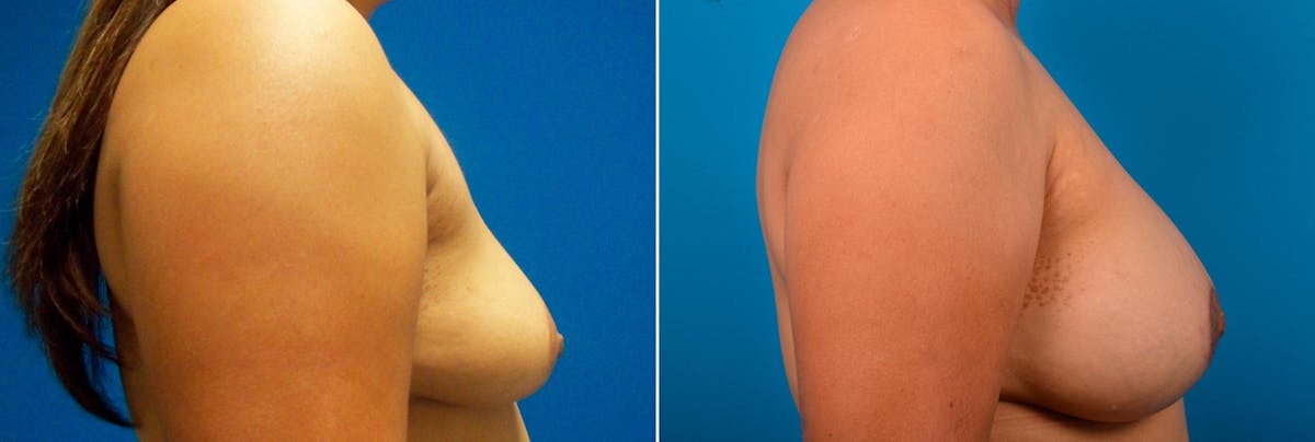Breast Augmentation and Lift Before & After Gallery - Patient 109858 - Image 2