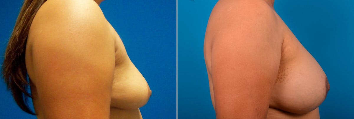 Hidden Breast Aug and Lift Before & After Gallery - Patient 183362 - Image 2