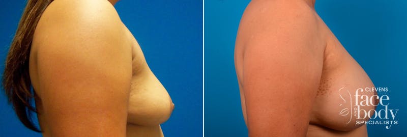 Hidden Breast Aug and Lift Before & After Gallery - Patient 267986 - Image 2