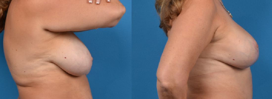 Hidden Breast Aug and Lift Before & After Gallery - Patient 871893 - Image 2