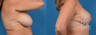 Hidden Breast Aug and Lift Before & After Gallery - Patient 871893 - Image 2