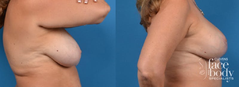 Hidden Breast Aug and Lift Before & After Gallery - Patient 871893 - Image 2