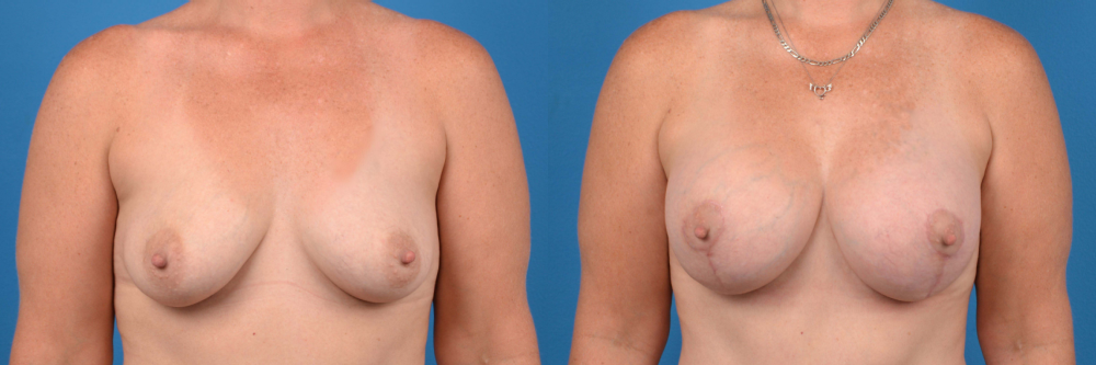 Hidden Breast Aug and Lift Before & After Gallery - Patient 103261 - Image 1
