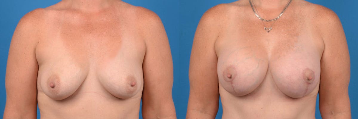 Breast Augmentation and Lift Before & After Gallery - Patient 111584 - Image 1