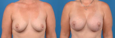 Breast Augmentation and Lift Before & After Gallery - Patient 122405402 - Image 1