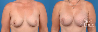 Hidden Breast Aug and Lift Before & After Gallery - Patient 103261 - Image 1