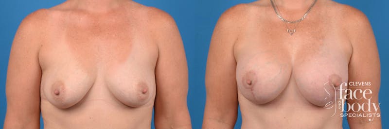 Hidden Breast Aug and Lift Before & After Gallery - Patient 103261 - Image 1