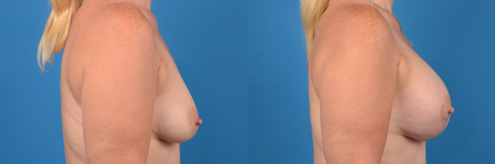Hidden Breast Aug and Lift Before & After Gallery - Patient 103261 - Image 2