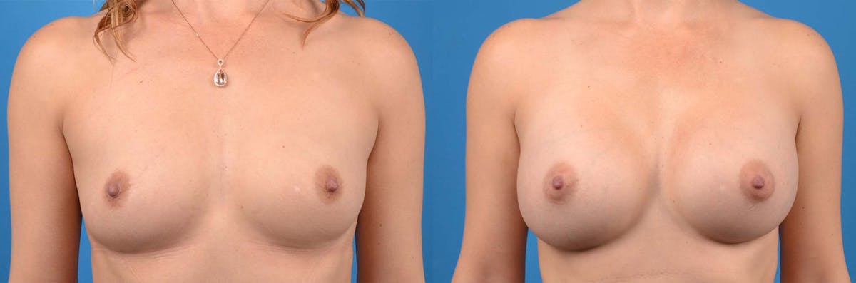 Breast Augmentation Before & After Gallery - Patient 537427 - Image 1