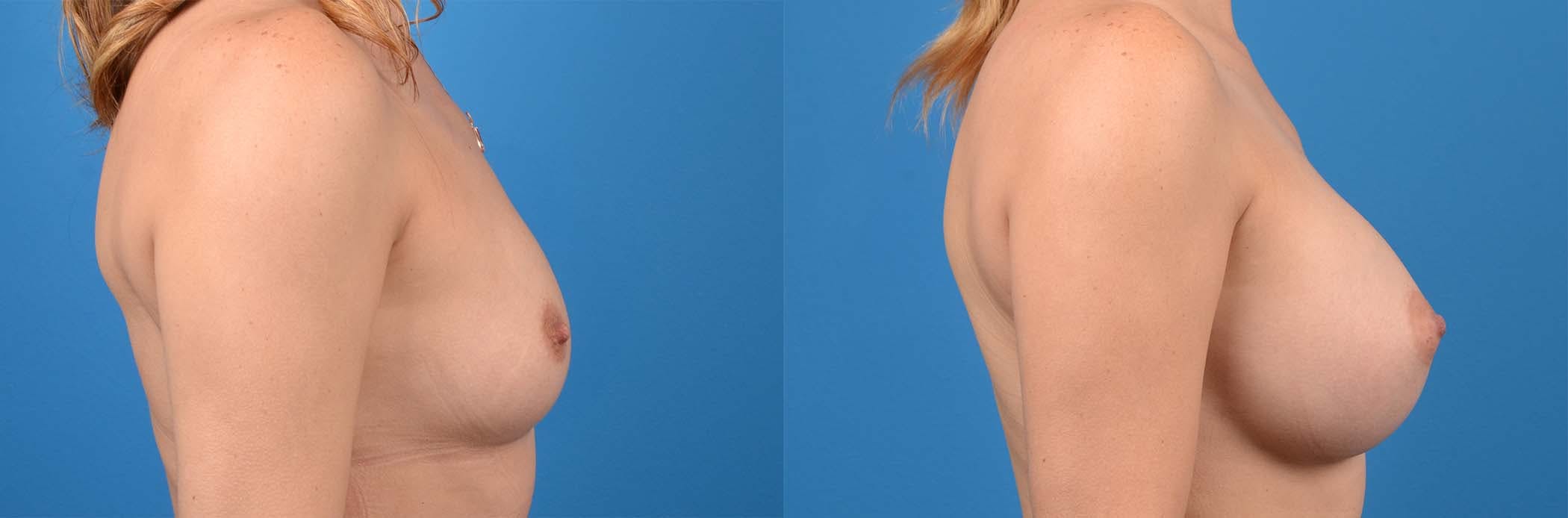Breast Augmentation Before & After Gallery - Patient 122405403 - Image 2