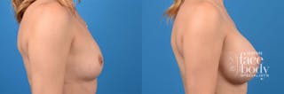 Hidden Breast Aug Before & After Gallery - Patient 906048 - Image 2