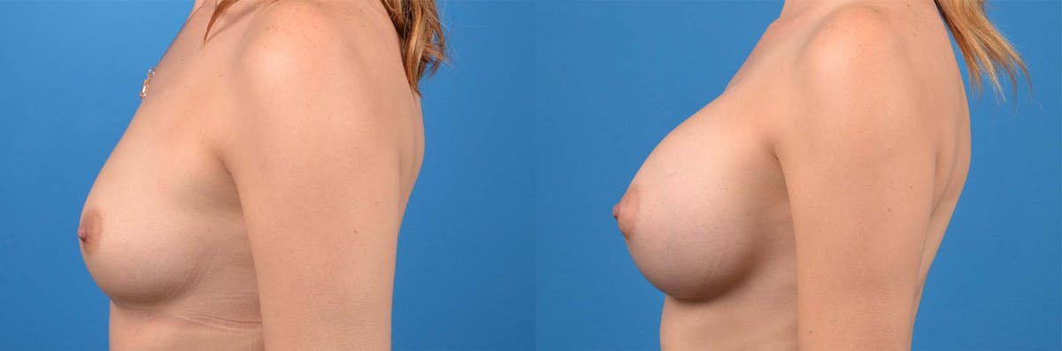 Breast Augmentation Before & After Gallery - Patient 537427 - Image 3