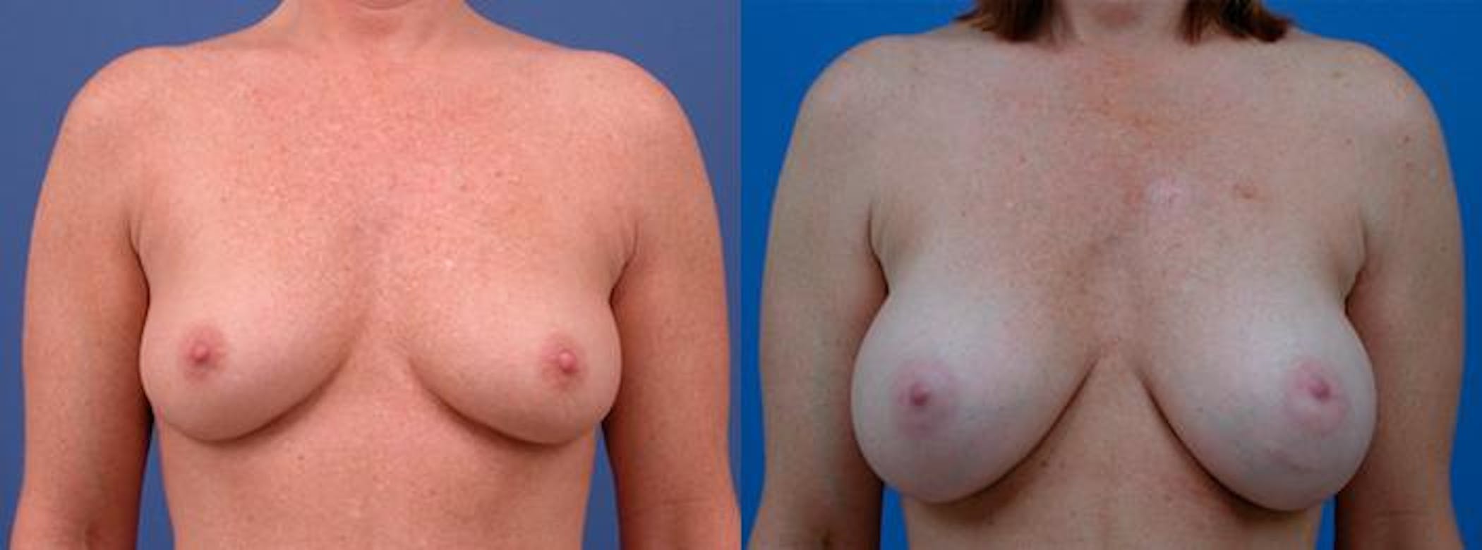 Results from Breast Augmentation in Merritt Island at Clevens Face and Body Specialists