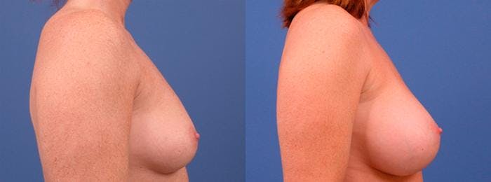 Breast Augmentation Before & After Gallery - Patient 122405404 - Image 2