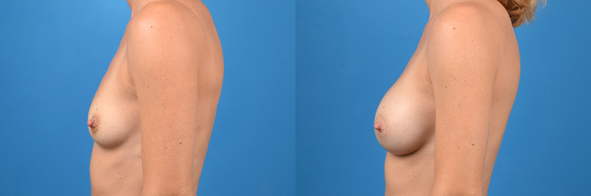 Hidden Breast Aug Before & After Gallery - Patient 411670 - Image 2