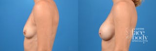 Hidden Breast Aug Before & After Gallery - Patient 102503 - Image 2