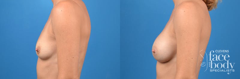 Hidden Breast Aug Before & After Gallery - Patient 102503 - Image 2