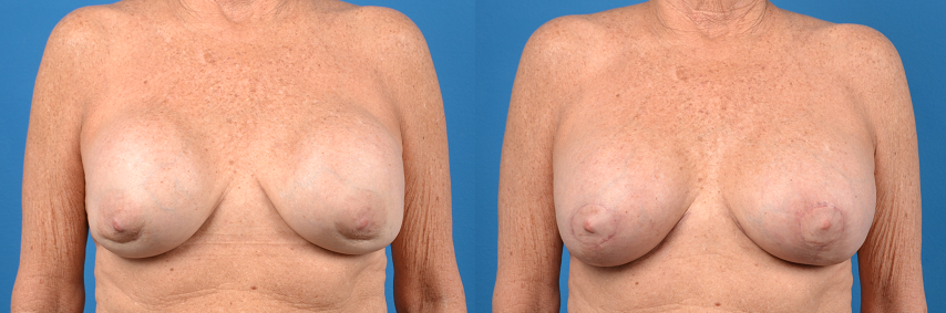 Hidden Breast Implant Exchange Before & After Gallery - Patient 704967 - Image 1