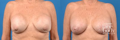 Hidden Breast Implant Exchange Before & After Gallery - Patient 704967 - Image 1