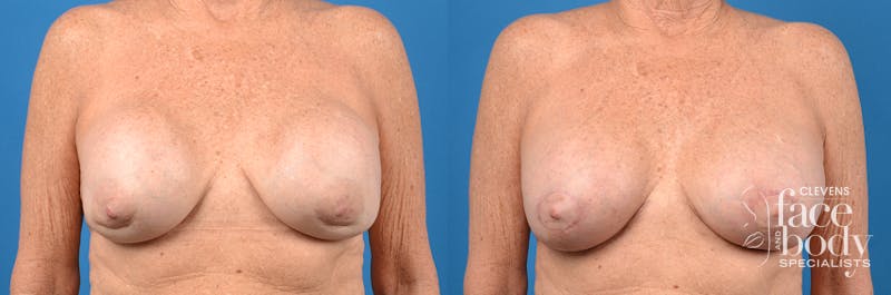 Hidden Breast Implant Exchange Before & After Gallery - Patient 122405408 - Image 1