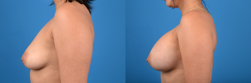 Hidden Breast Aug Before & After Gallery - Patient 347016 - Image 2