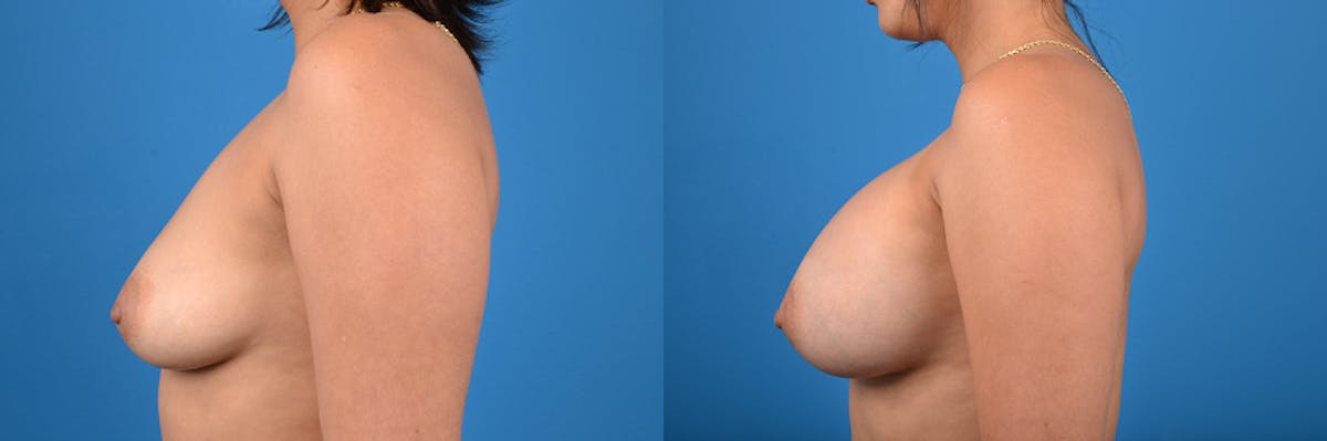 Breast Augmentation Before & After Gallery - Patient 122405407 - Image 2