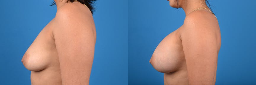 Breast Augmentation Before & After Gallery - Patient 122405407 - Image 2