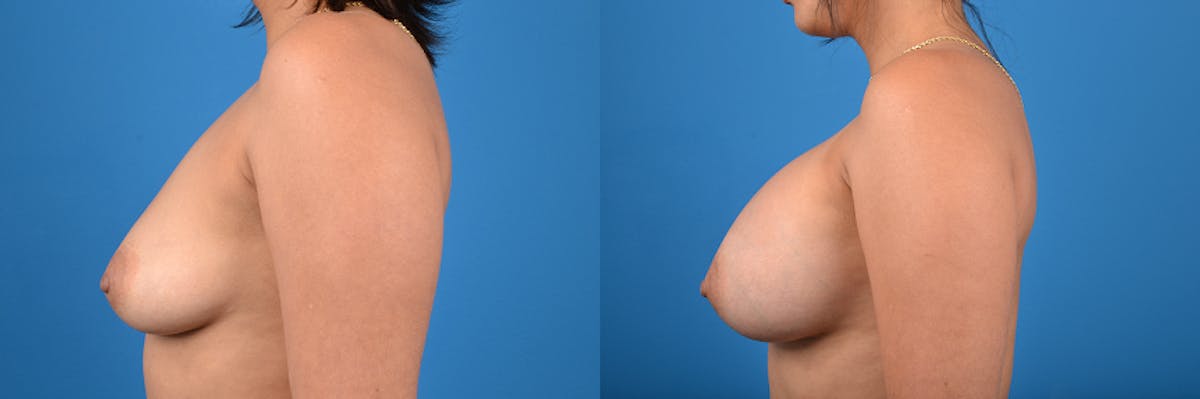 Breast Augmentation Before & After Gallery - Patient 304858 - Image 2
