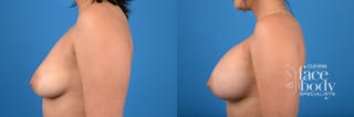 Hidden Breast Aug Before & After Gallery - Patient 106811 - Image 2