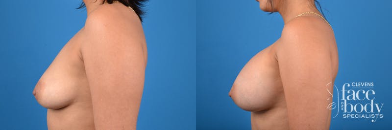 Hidden Breast Aug Before & After Gallery - Patient 106811 - Image 2