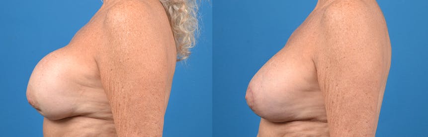 Breast Implant Exchange Before & After Gallery - Patient 122405408 - Image 2