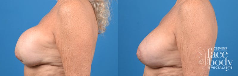 Hidden Breast Implant Exchange Before & After Gallery - Patient 122405408 - Image 2
