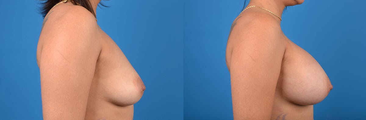 Breast Augmentation Before & After Gallery - Patient 122405407 - Image 3