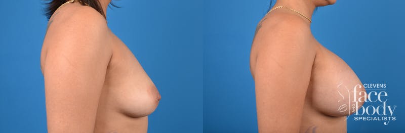 Hidden Breast Aug Before & After Gallery - Patient 106811 - Image 3