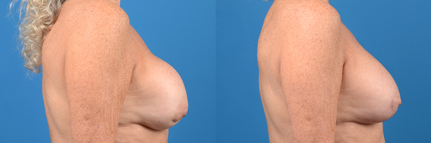 Hidden Breast Implant Exchange Before & After Gallery - Patient 122405408 - Image 3
