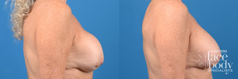 Hidden Breast Implant Exchange Before & After Gallery - Patient 122405408 - Image 3