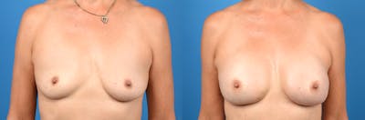 Breast Augmentation Before & After Gallery - Patient 122405409 - Image 1