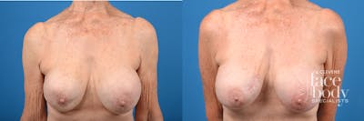 Hidden Breast Implant Exchange Before & After Gallery - Patient 123325 - Image 1