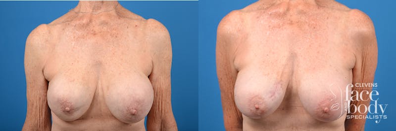 Hidden Breast Implant Exchange Before & After Gallery - Patient 122405410 - Image 1