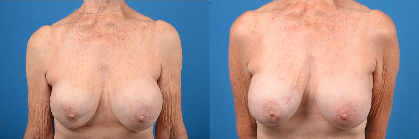 Breast Implant Exchange Before & After Gallery - Patient 122405410 - Image 1
