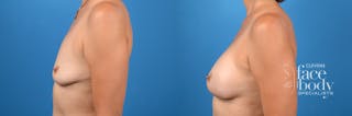 Hidden Breast Aug Before & After Gallery - Patient 324104 - Image 2
