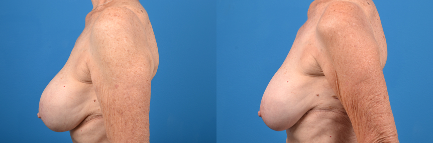 Hidden Breast Implant Exchange Before & After Gallery - Patient 123325 - Image 2