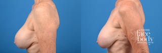Hidden Breast Implant Exchange Before & After Gallery - Patient 122405410 - Image 2