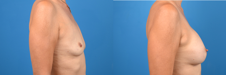 Hidden Breast Aug Before & After Gallery - Patient 123712 - Image 3